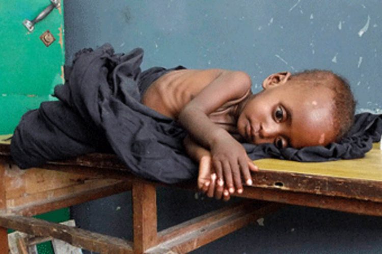 malnutrition