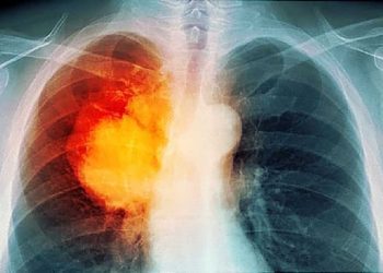 lung_cancer