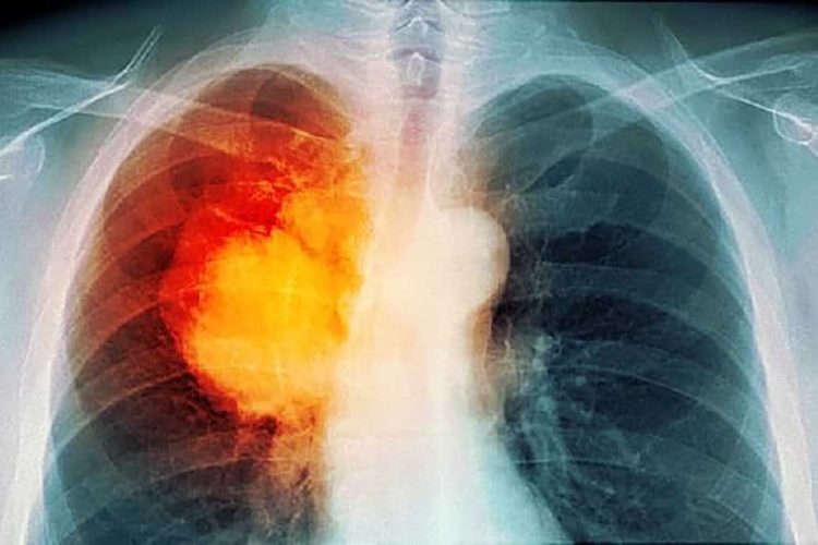 lung_cancer